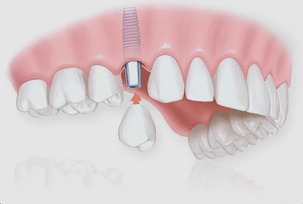 Одномоментная имплантация: цена и преимущества